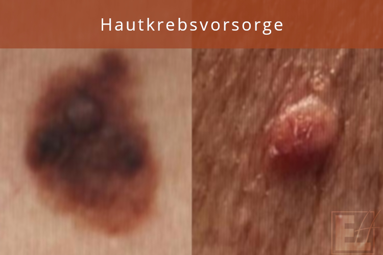 Hautkrebsvorsorge