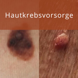 Hautkrebsvorsorge Vorschau